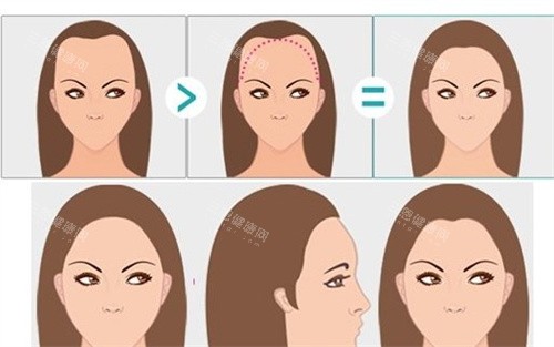 南京蘿愛美麗再生怎么樣?是植發(fā)實(shí)力機(jī)構(gòu),超微針技術(shù)單價親民成效直觀